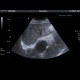 Periportal fibrosis: US - Ultrasound